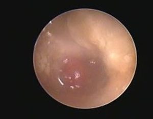 Endoscopia: Pólipos auriculares em gatos (imagem 2 de 3)
