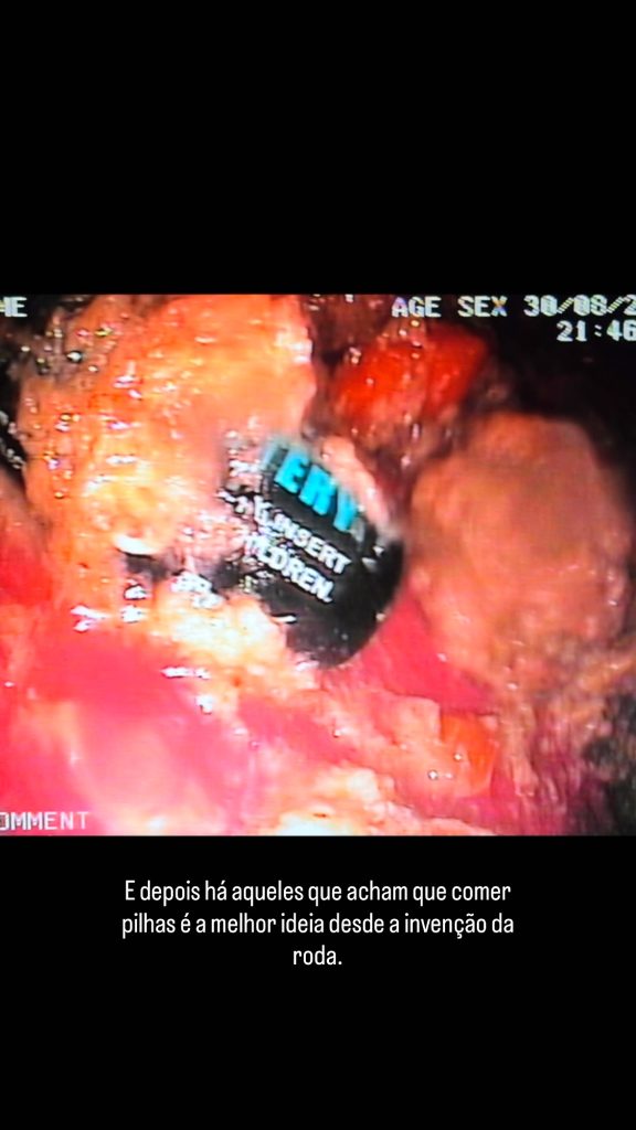 Endoscopia: Corpos estranhos gástricos e endoscopia