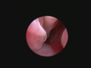 Endoscopia: Intensidade luminosa na endoscopia (imagem 2 de 2)