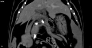 Medicina Interna: Litíase pancreática rara em gatos (imagem 2 de 2)