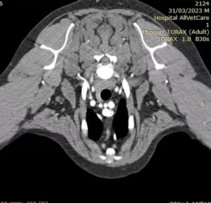 TAC: Tromboembolismo pulmonar revelado por TAC (imagem 1 de 3)