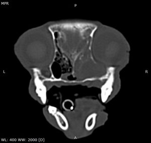 Dentisteria e Odontologia: Abcesso periapical e sinais respiratórios (imagem 3 de 4)
