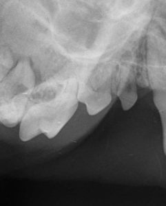 Dentisteria e Odontologia: Radiologia oral na doença periodontal (imagem 5 de 6)