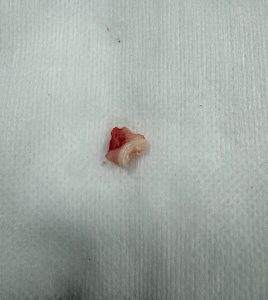 Dentisteria e Odontologia: Dente deslocado para a órbita após mordedura (imagem 2 de 2)
