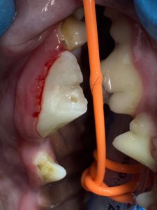 Dentisteria e Odontologia: Fratura dentária por objetos rígidos (imagem 2 de 5)